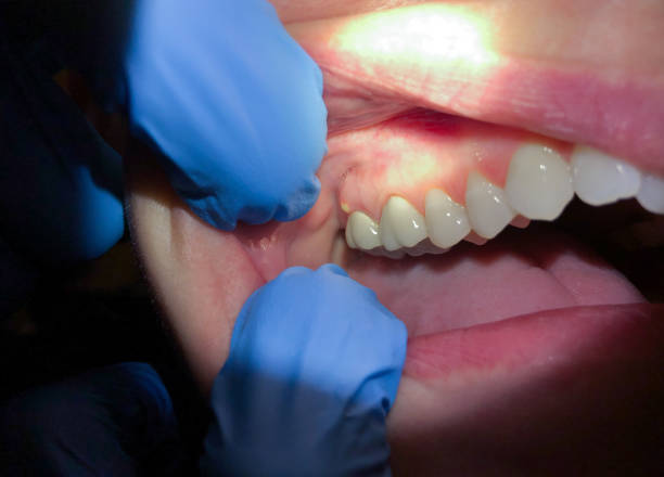 Best Emergency Root Canal Therapy in Palestine, TX