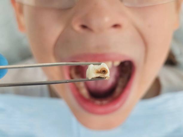 Best Knocked-Out Tooth (Avulsed Tooth) Treatment in Palestine, TX